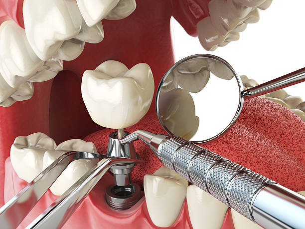 Best Broken or Chipped Tooth Repair in Rochester, MI